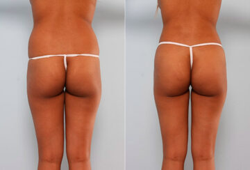 Butt Augmentation before and after photos in Houston, TX, Patient 27928