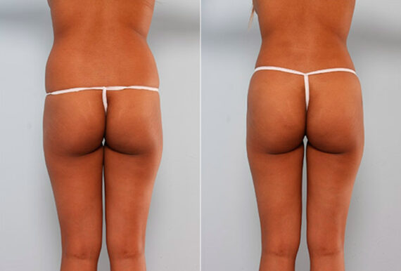 Butt Augmentation before and after photos in Houston, TX, Patient 27928