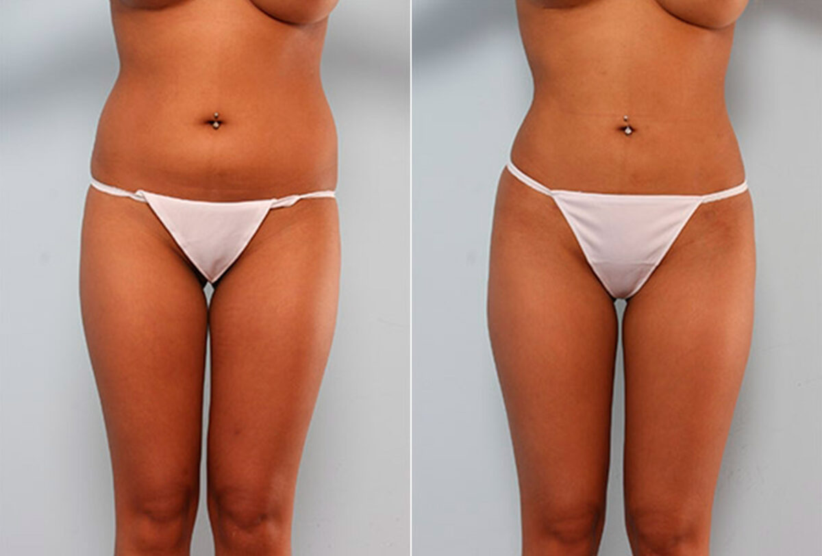 Butt Augmentation before and after photos in Houston, TX, Patient 27928