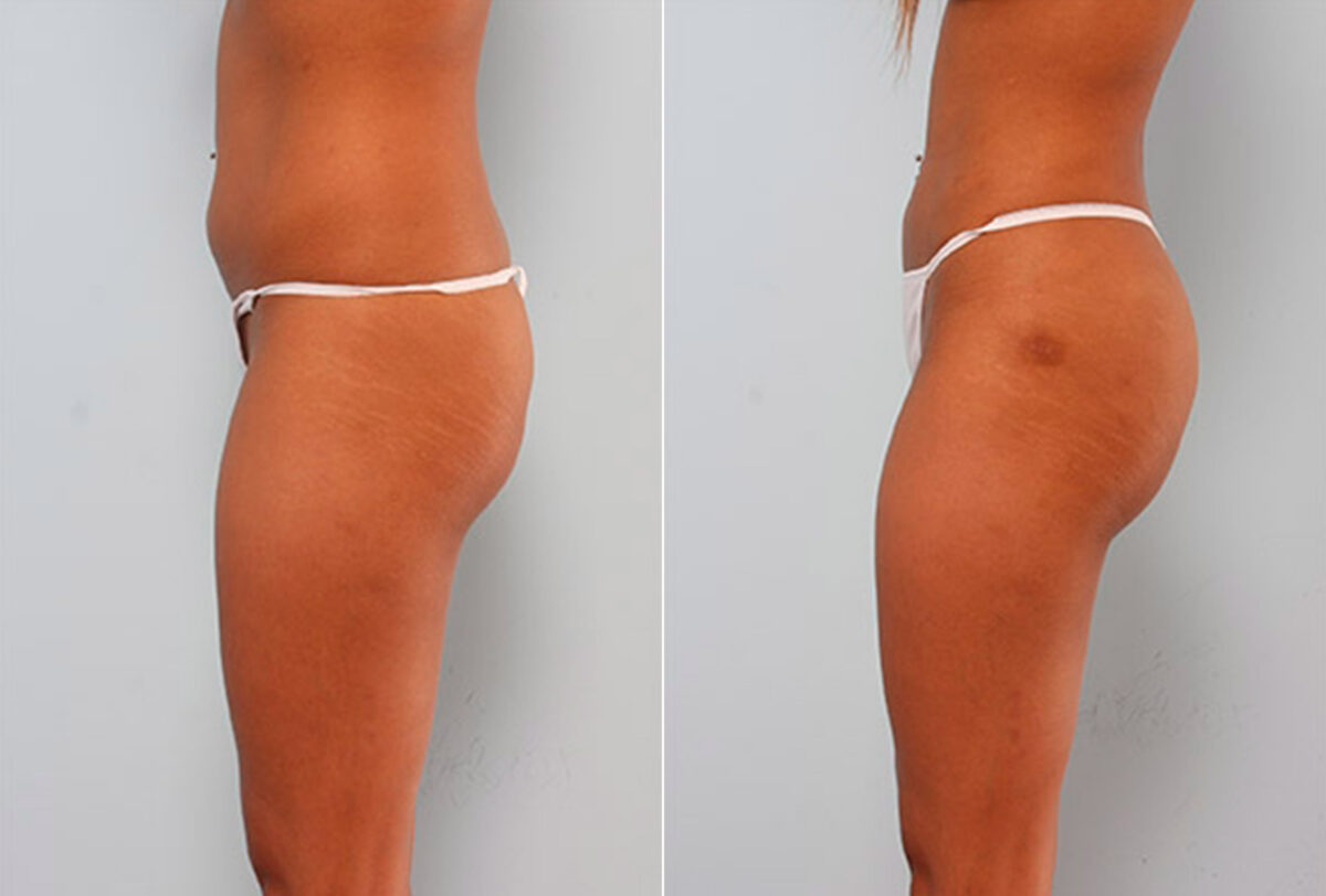 Butt Augmentation before and after photos in Houston, TX, Patient 27928