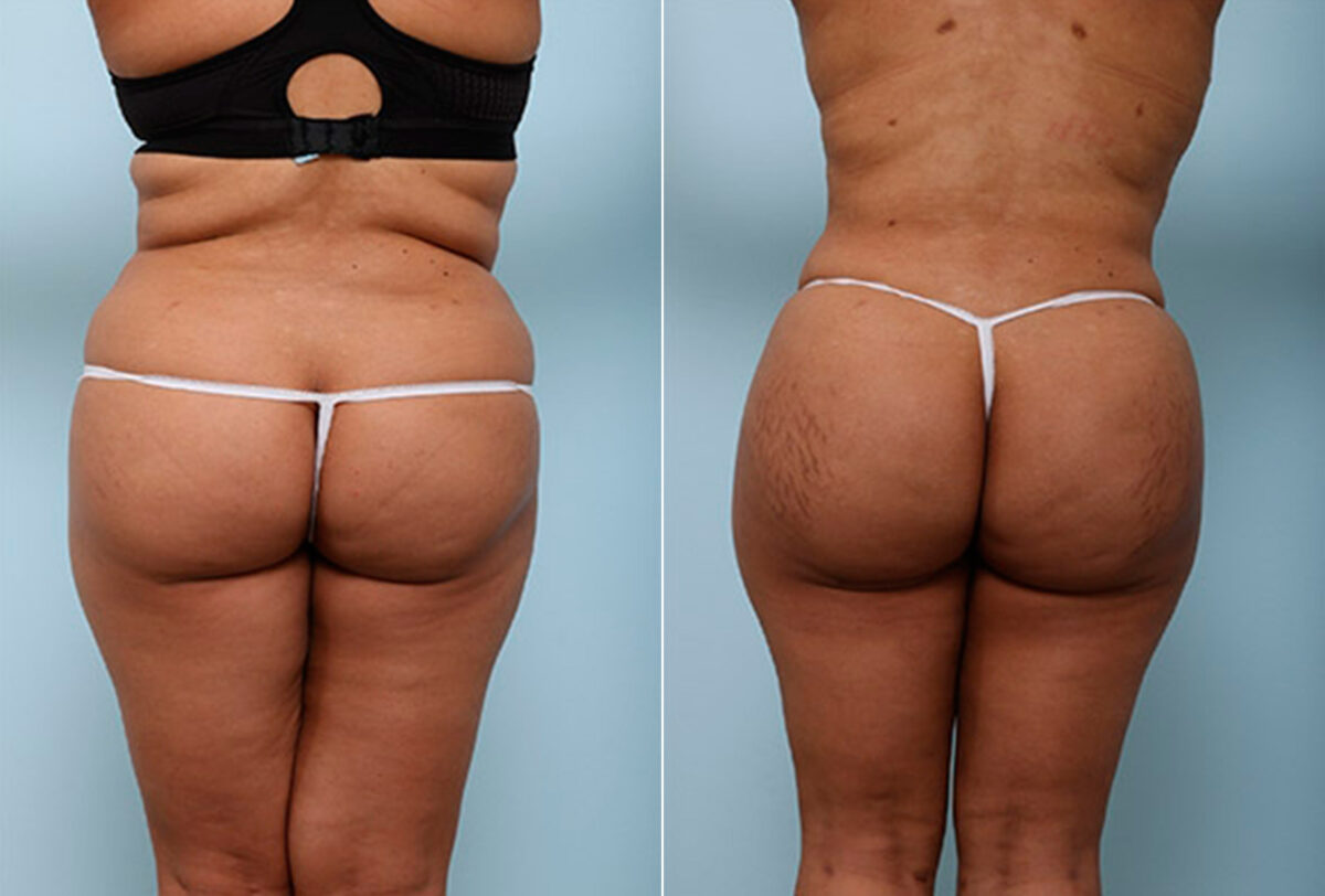 Butt Augmentation before and after photos in Houston, TX, Patient 27935