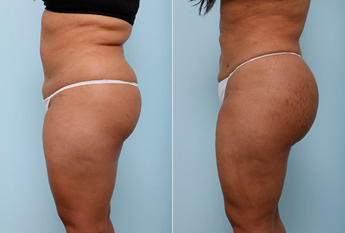 Butt Augmentation before and after photos in Houston, TX, Patient 27935