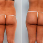 Butt Augmentation before and after photos in Houston, TX, Patient 27942