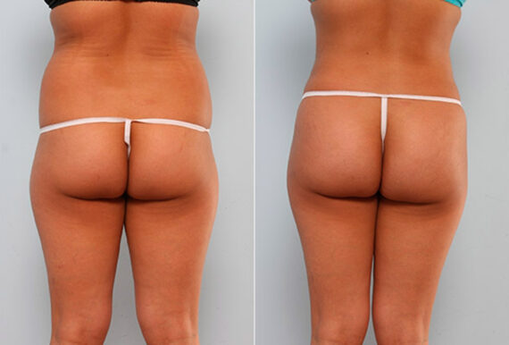 Butt Augmentation before and after photos in Houston, TX, Patient 27942