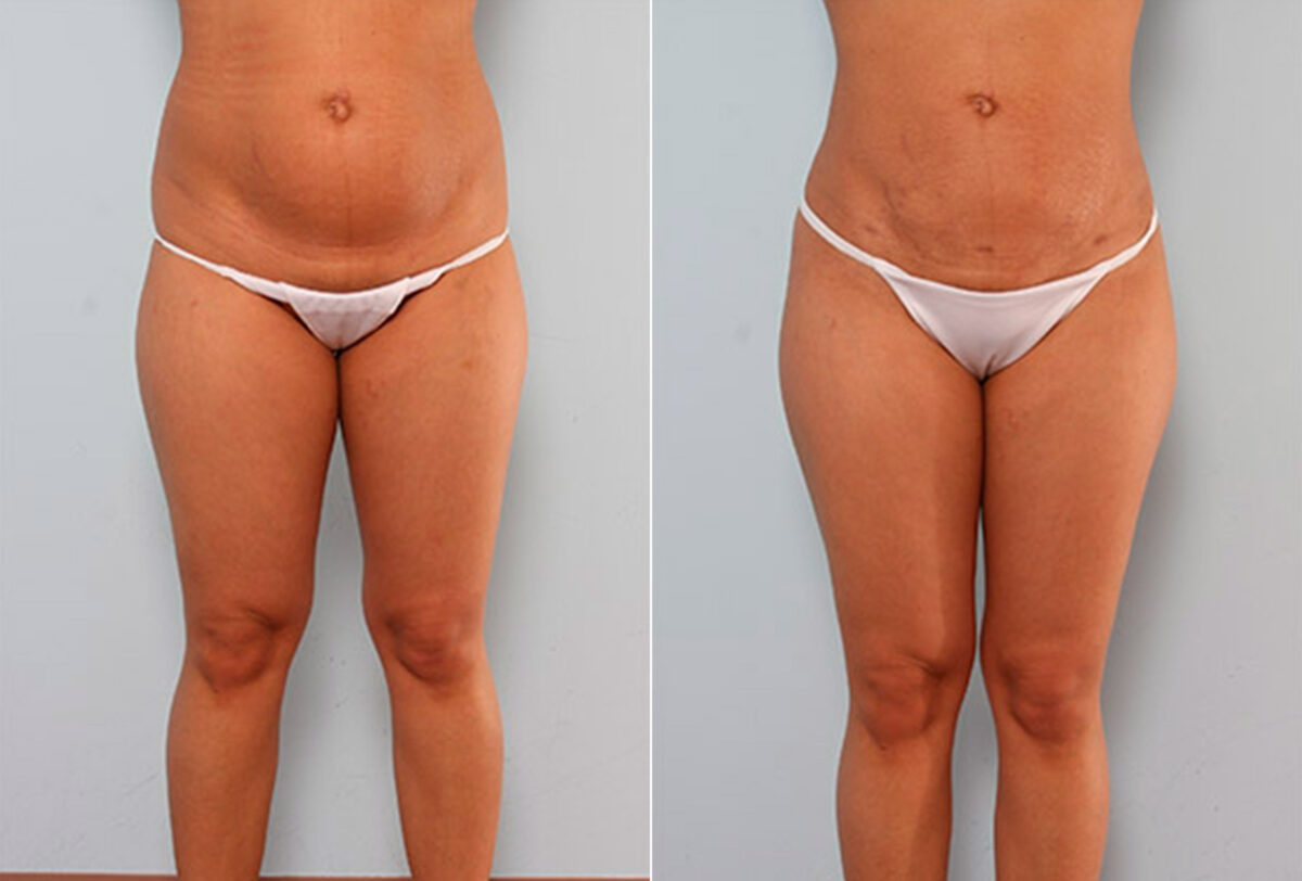 Butt Augmentation before and after photos in Houston, TX, Patient 27942