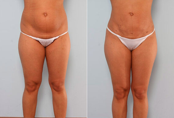 Butt Augmentation before and after photos in Houston, TX, Patient 27942