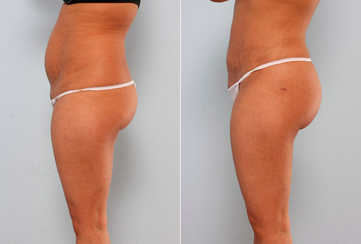 Butt Augmentation before and after photos in Houston, TX, Patient 27942