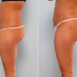 Butt Augmentation before and after photos in Houston, TX, Patient 27942