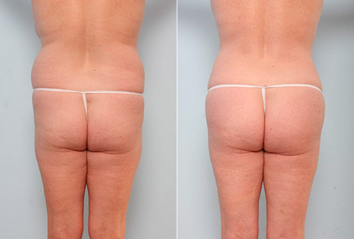 Butt Augmentation before and after photos in Houston, TX, Patient 27949