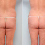 Butt Augmentation before and after photos in Houston, TX, Patient 27949