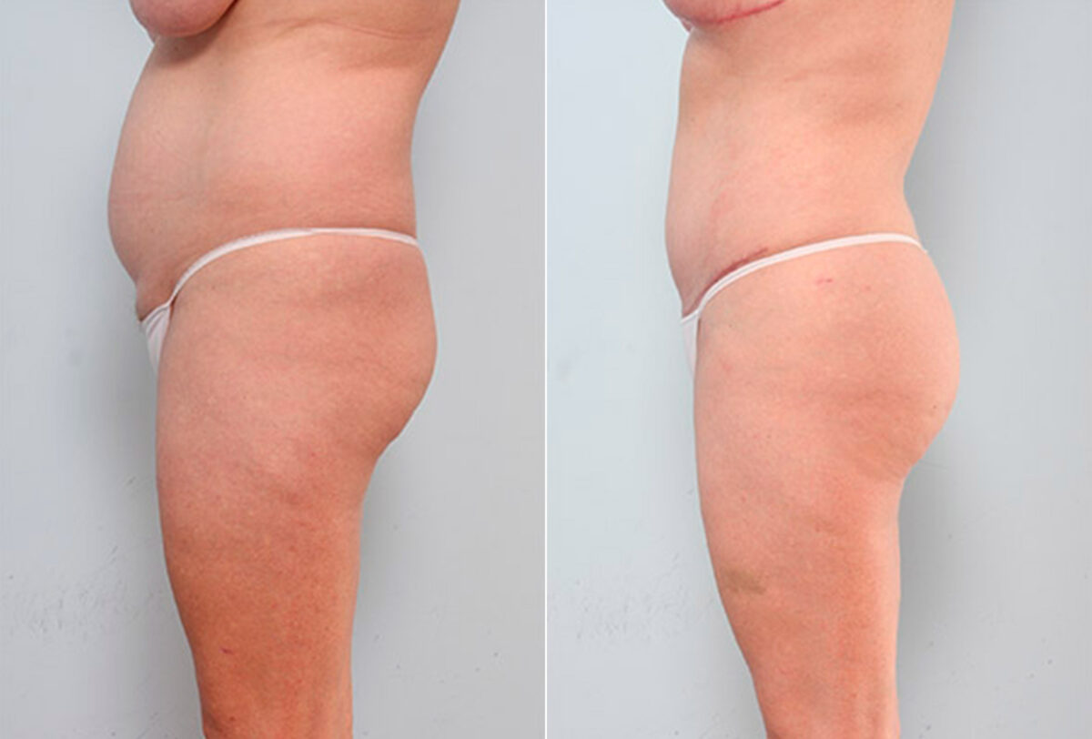 Butt Augmentation before and after photos in Houston, TX, Patient 27949