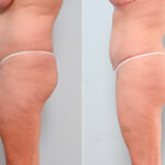 Butt Augmentation before and after photos in Houston, TX, Patient 27949