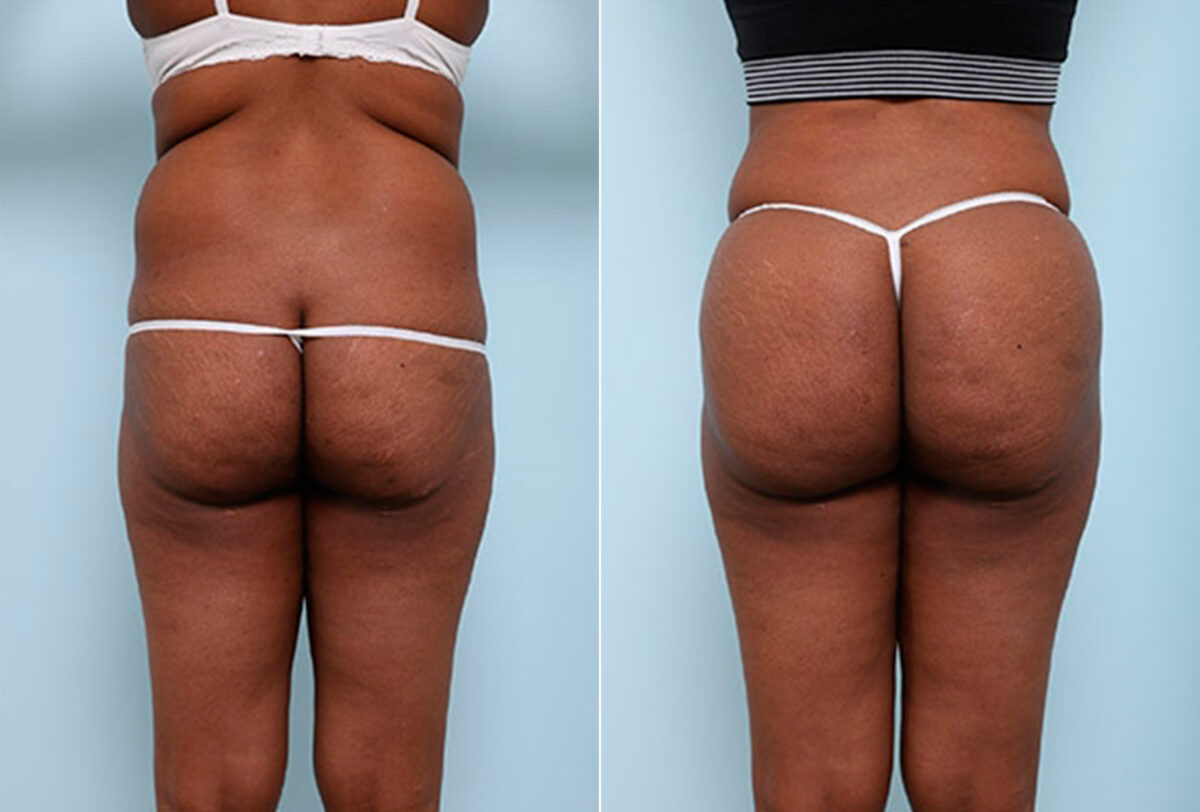 Butt Augmentation before and after photos in Houston, TX, Patient 27956