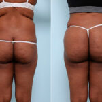 Butt Augmentation before and after photos in Houston, TX, Patient 27956