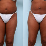 Butt Augmentation before and after photos in Houston, TX, Patient 27956