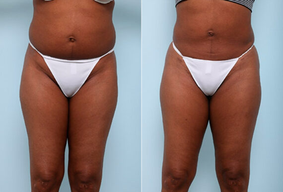 Butt Augmentation before and after photos in Houston, TX, Patient 27956