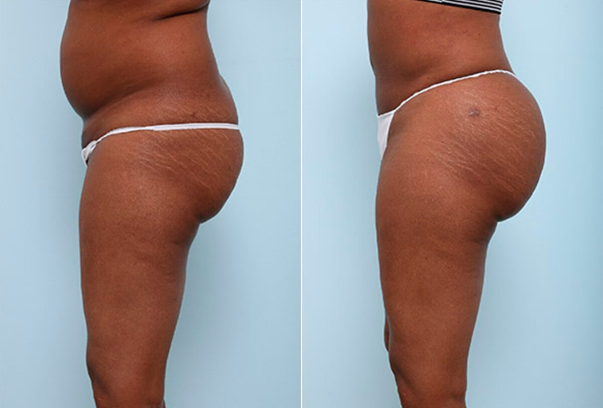 Butt Augmentation before and after photos in Houston, TX, Patient 27956