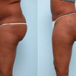 Butt Augmentation before and after photos in Houston, TX, Patient 27956