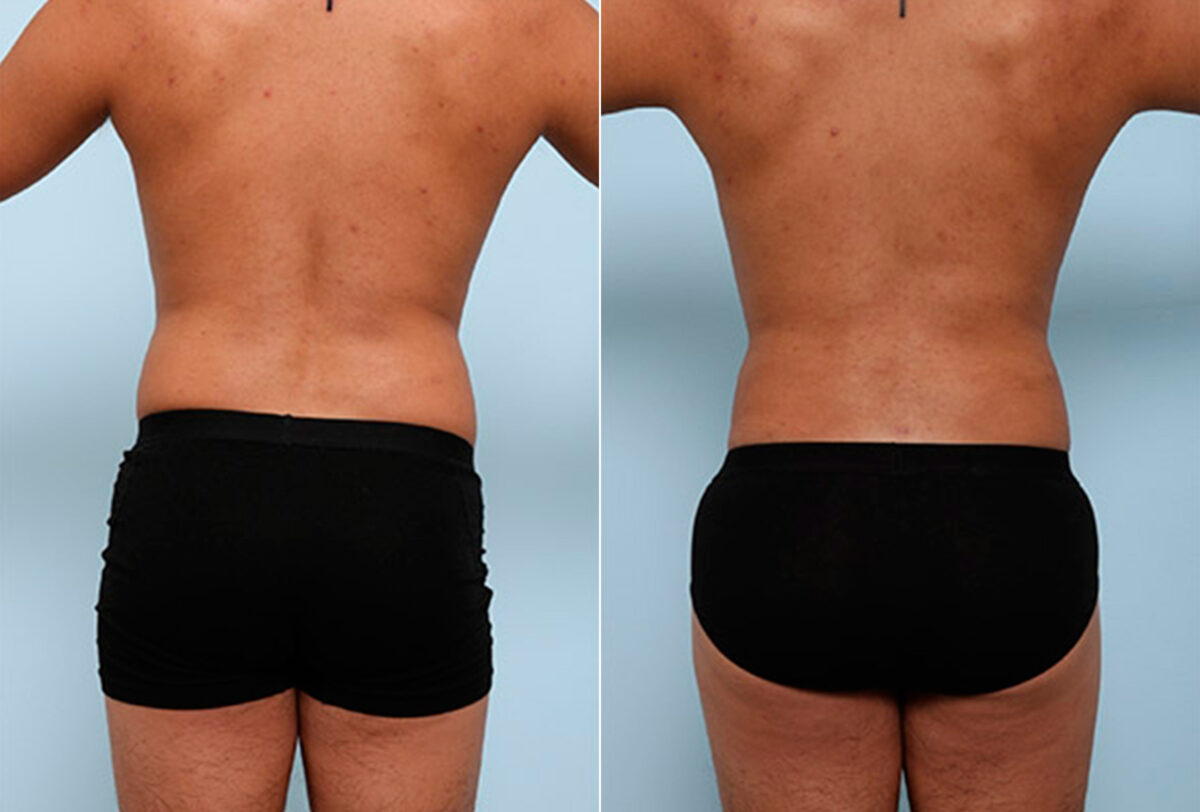 Butt Augmentation before and after photos in Houston, TX, Patient 27963