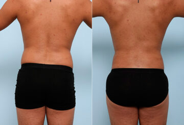 Butt Augmentation before and after photos in Houston, TX, Patient 27963