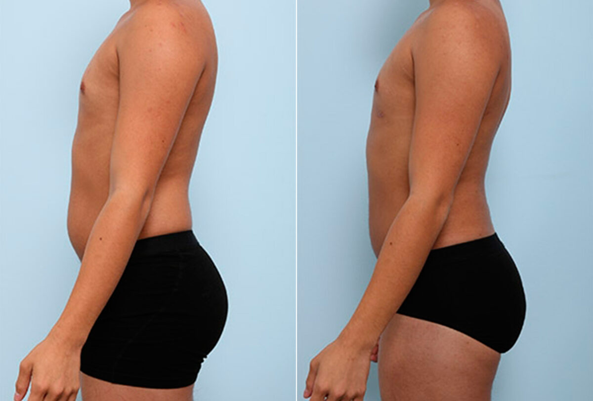 Butt Augmentation before and after photos in Houston, TX, Patient 27963