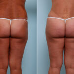 Butt Augmentation before and after photos in Houston, TX, Patient 27970