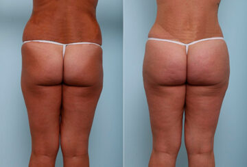 Butt Augmentation before and after photos in Houston, TX, Patient 27970
