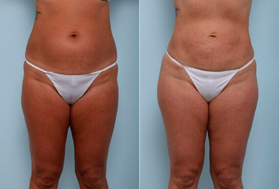 Butt Augmentation before and after photos in Houston, TX, Patient 27970