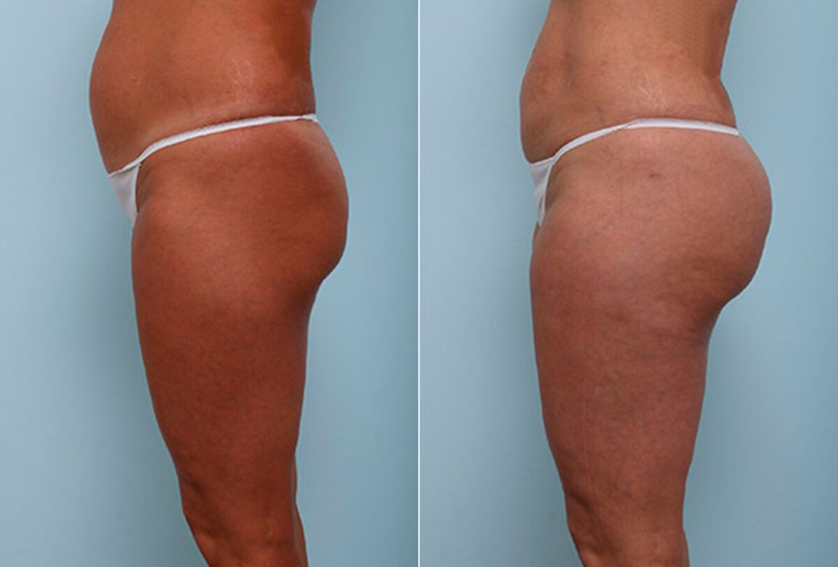 Butt Augmentation before and after photos in Houston, TX, Patient 27970