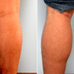 Calf Implants before and after photos in Houston, TX, Patient 27977