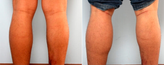 Calf Implants before and after photos in Houston, TX, Patient 27977