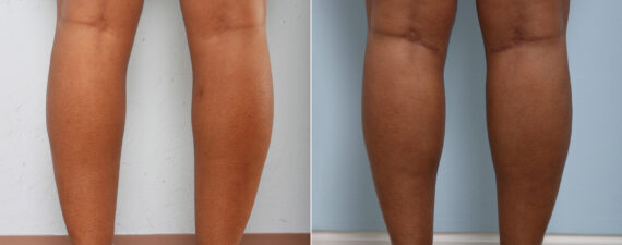 Calf Implants before and after photos in Houston, TX, Patient 27980