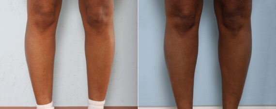 Calf Implants before and after photos in Houston, TX, Patient 27980