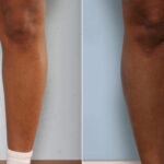 Calf Implants before and after photos in Houston, TX, Patient 27985