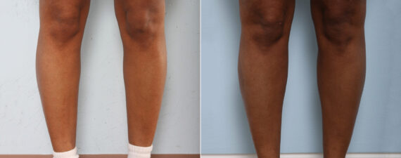 Calf Implants before and after photos in Houston, TX, Patient 27985