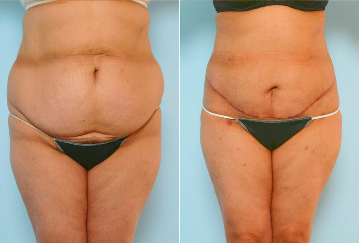 Abdominoplasty before and after photos in Houston, TX, Patient 24579