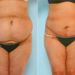 Abdominoplasty before and after photos in Houston, TX, Patient 24579