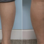 Calf Implants before and after photos in Houston, TX, Patient 27990