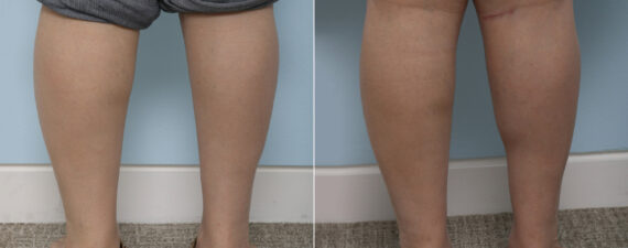 Calf Implants before and after photos in Houston, TX, Patient 27990