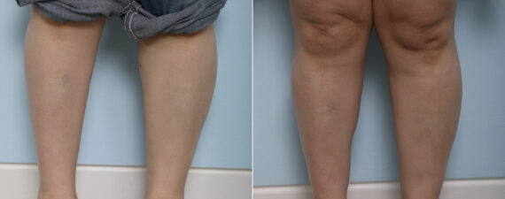 Calf Implants before and after photos in Houston, TX, Patient 27990