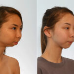 Chin Augmentation before and after photos in Houston, TX, Patient 27995