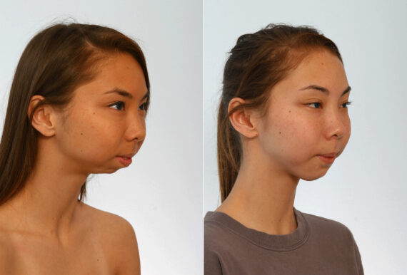 Chin Augmentation before and after photos in Houston, TX