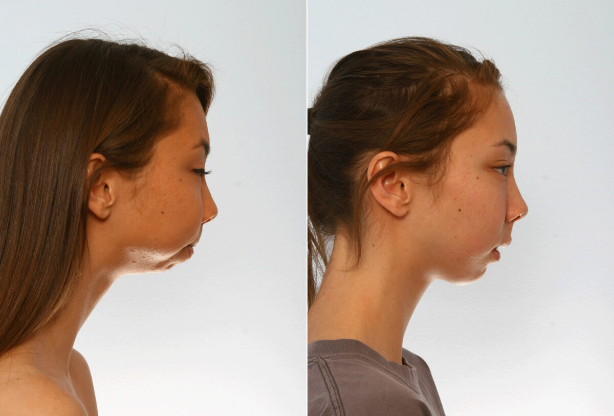 Chin Augmentation before and after photos in Houston, TX, Patient 27995