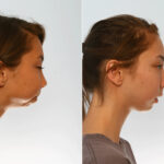 Chin Augmentation before and after photos in Houston, TX, Patient 27995