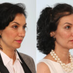 Chin Augmentation before and after photos in Houston, TX, Patient 28000