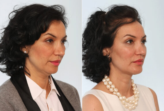 Chin Augmentation before and after photos in Houston, TX