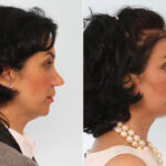 Chin Augmentation before and after photos in Houston, TX, Patient 28000