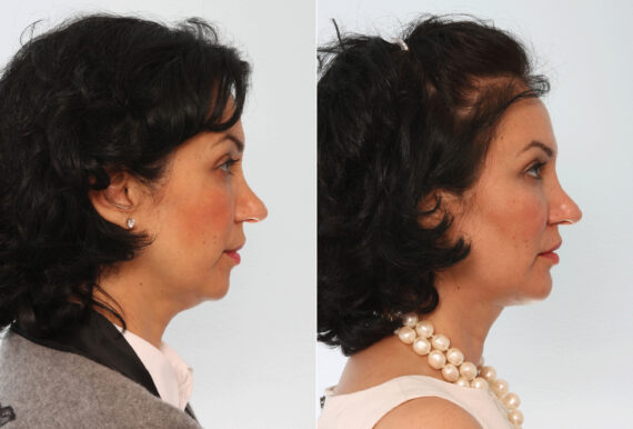 Chin Augmentation before and after photos in Houston, TX, Patient 28000