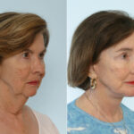Chin Augmentation before and after photos in Houston, TX, Patient 28005