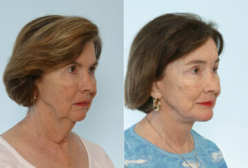 Chin Augmentation before and after photos in Houston, TX, Patient 28005